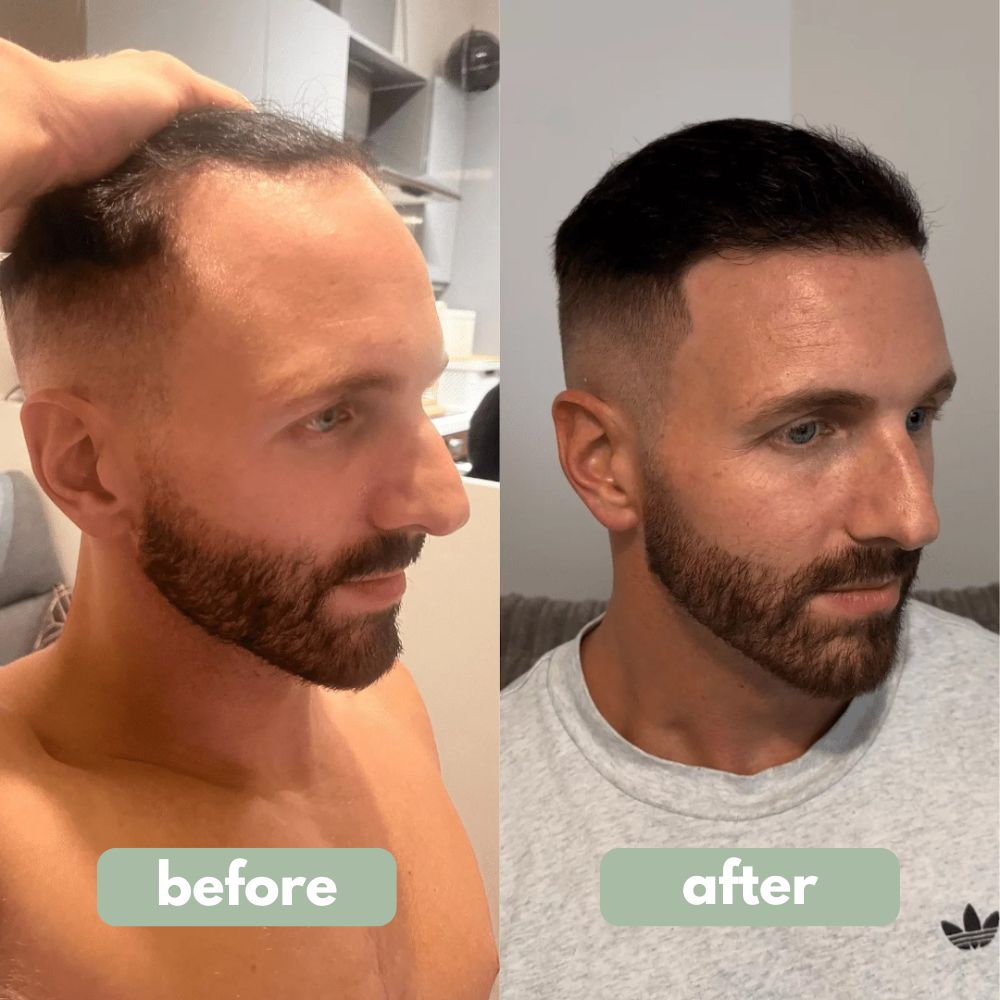 Reverse - Haarwuchsserum